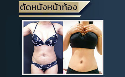 ตัดหนังหน้าท้อง